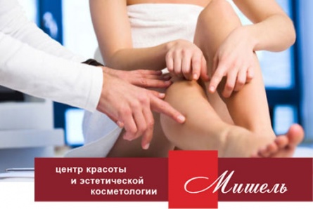 Удаление сосудов и сосудистых звездочек со скидкой 50% в салоне красоты “Мишель”